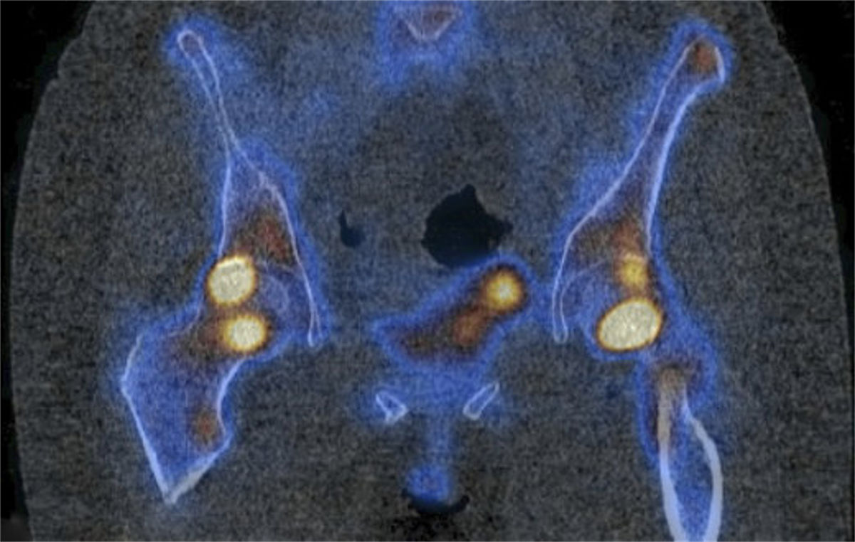 Knochenbrüche nach Eisenmangel: Wahl des Eisenpräparats beeinflusst Frakturrisiko