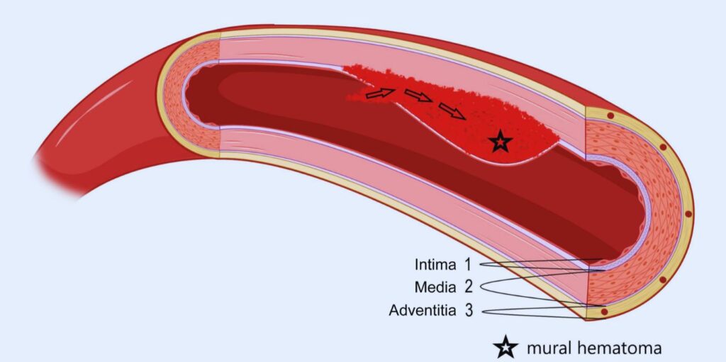 Die Grafik zeigt ein Hämatom in der Gefäßwand der Schlagader, das mit einem erhöhten Schlaganfallrisiko einhergeht.
Grafik: Dejakum B, Kiechl S, Knoflach M and Mayer-Suess L (2024) A narrative review on cervical artery dissection-related cranial nerve palsies. Front. Neurol. 15:1364218. doi: 10.3389/fneur.2024.1364218